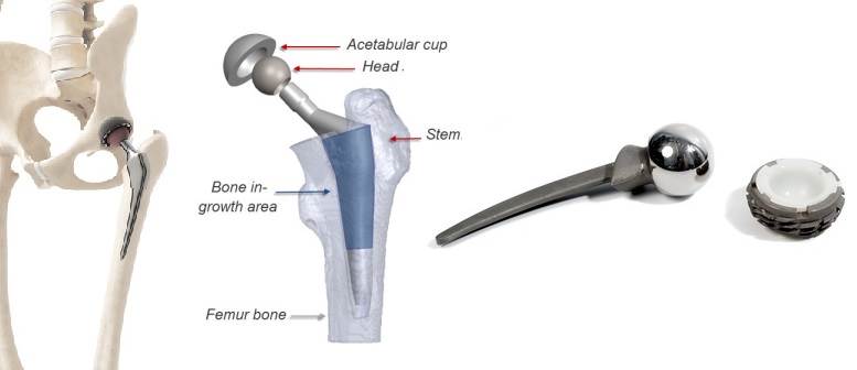 Normal hip joint morphology and hip implant.