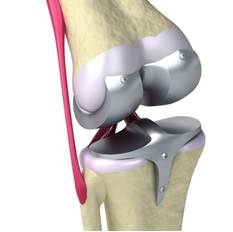 Illustration of a traditional knee implant